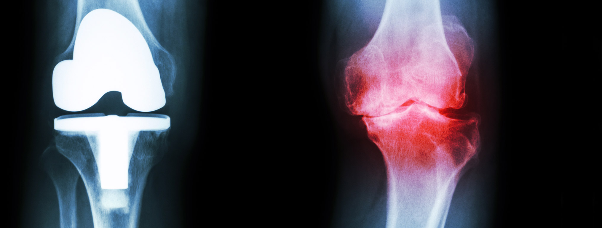 scan of arthritic knees