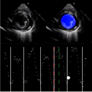 two side by side echocardiogram image one with a blue circle represented as its annotation