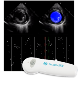 A snippet of an echocardiogram image with blue circle as it's annotation and a picture of a handheld ultrasound device